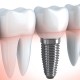 Implante dental fijo
